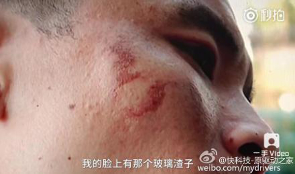男子手部和臉部不同程度被炸傷。